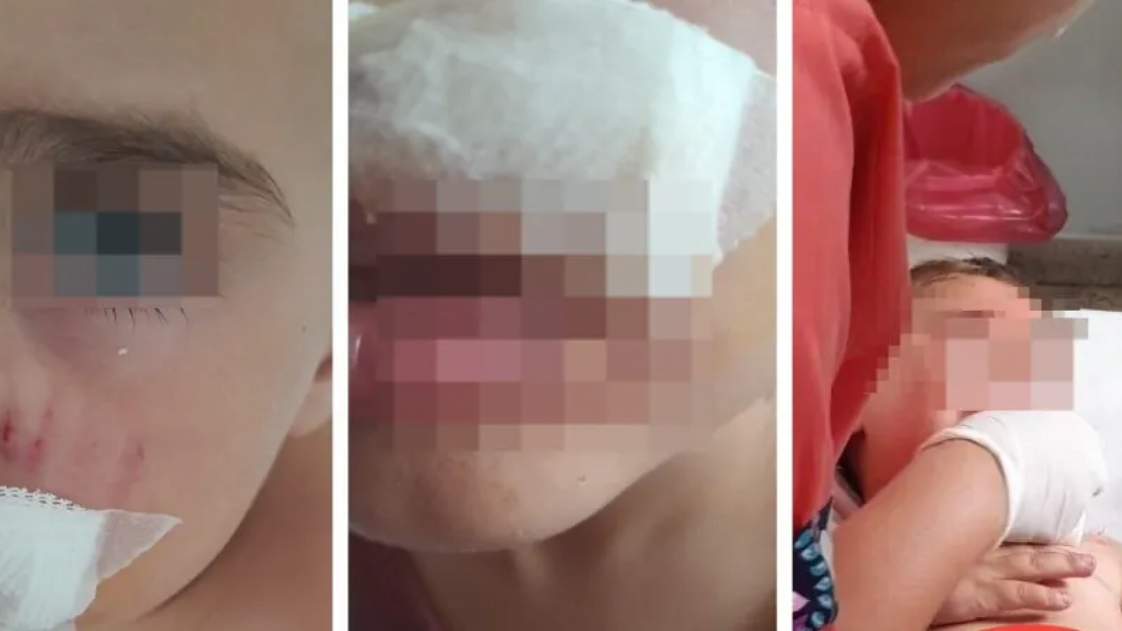 Brutal ataque de perro en Rawson: un niño de 4 años fue mordido y la dueña "no se hizo cargo"