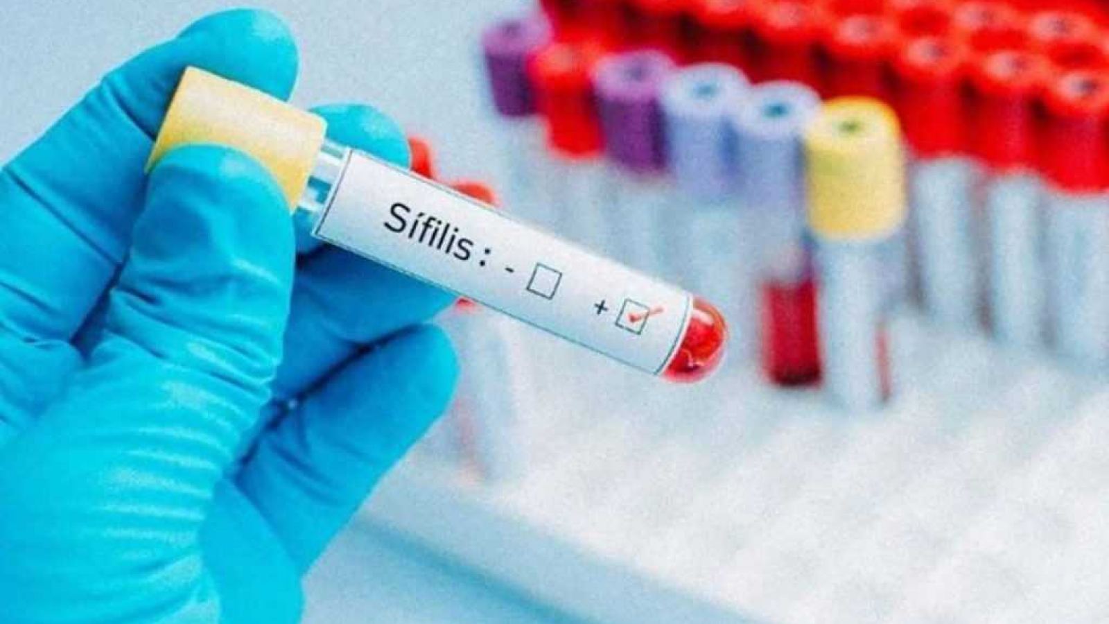 Alerta por el crecimiento de la sífilis en Chubut: registraron 383 casos hasta comienzos de julio